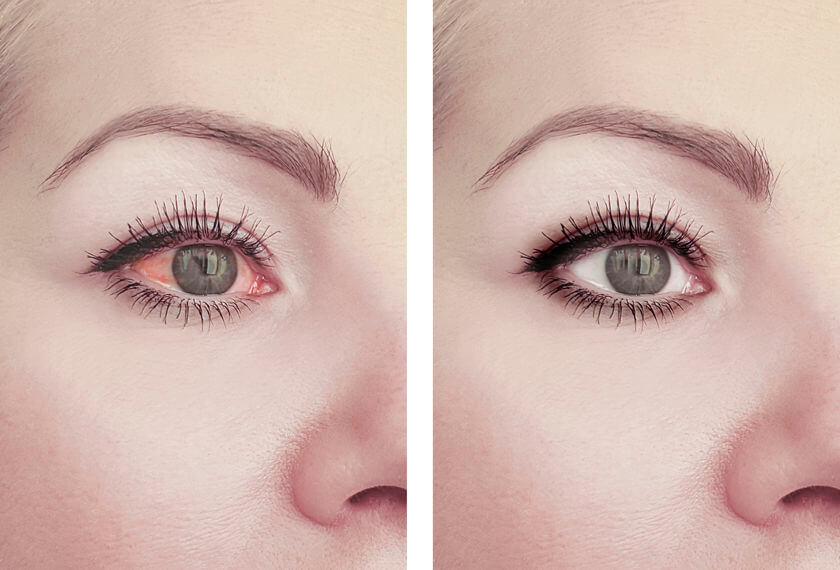 Why Does Marijuana Make Your Eyes Red? MedWell Health and Wellness